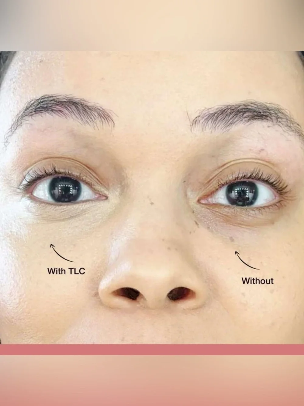 Jerome Alexander undereye tightener